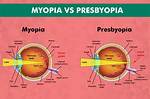 Will Presbyopia Offset Myopia?