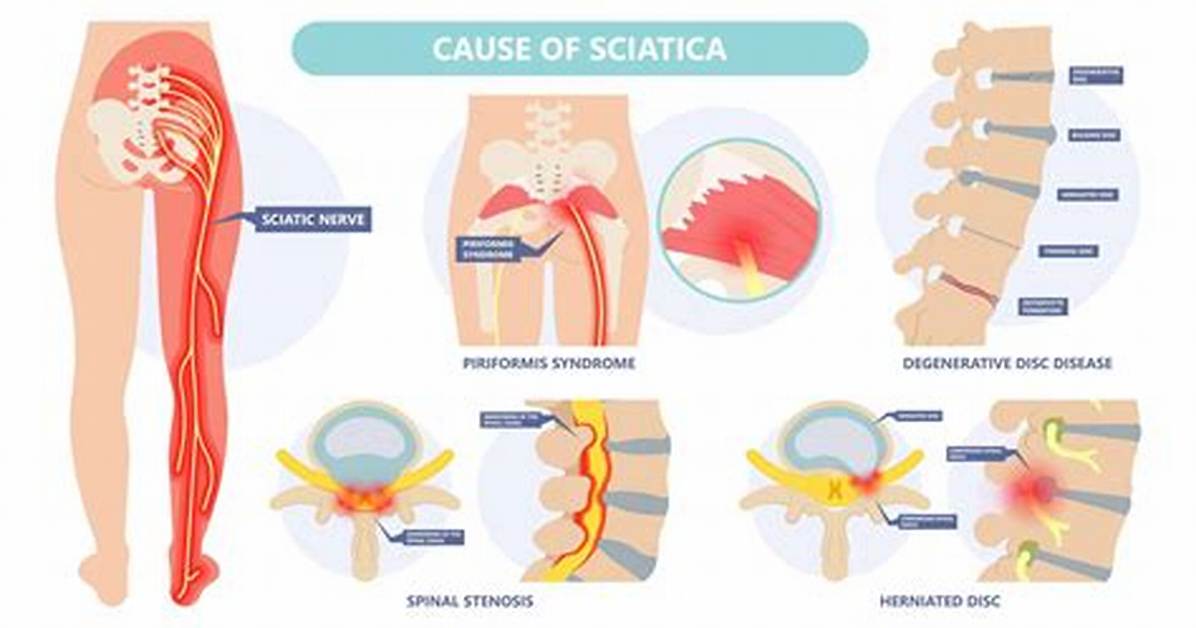 Will Sciatica Ever Go Away?