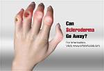Will Scleroderma Go Away?