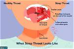 Will Strep Go Away?