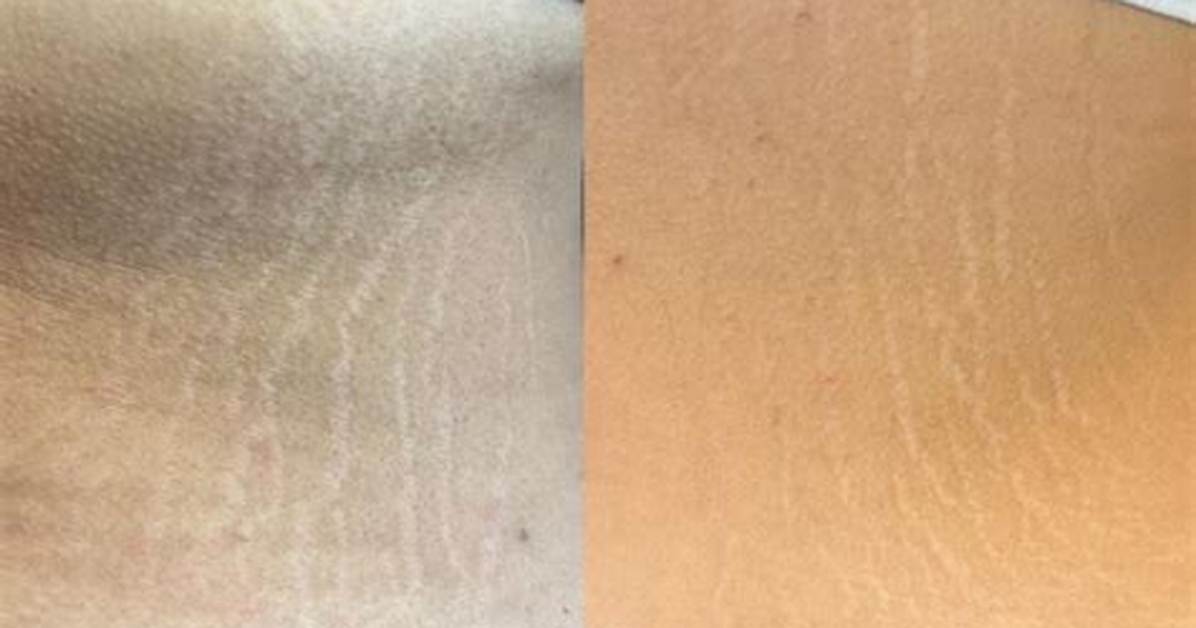 Will Stretch Marks Disappear?