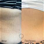 Will Stretch Marks Disappear?