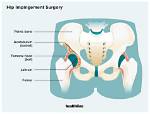Will Surgery Help Impingement?