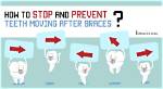 Will Teeth Ever Stop Moving?