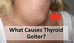 Will Thyroiditis Go Away?