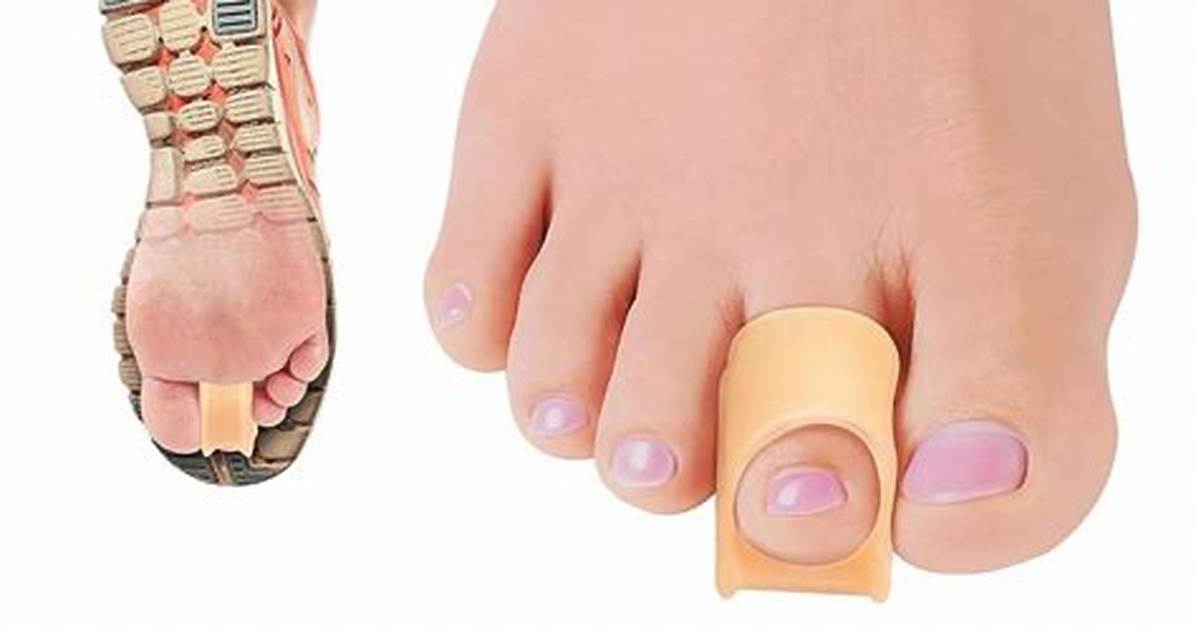 Will Toe Straighteners Work?