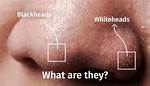 Will Whiteheads Eventually Go Away?