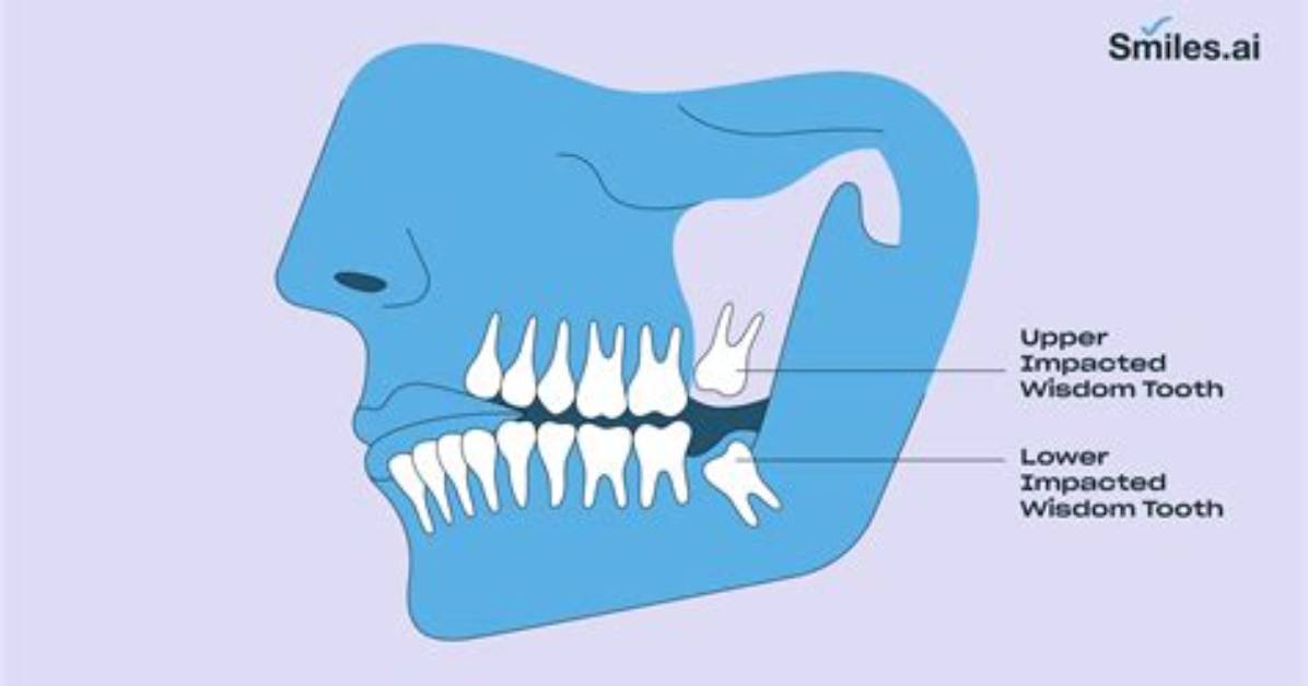 Wisdom Tooth for Example