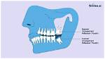 Wisdom Tooth for Example