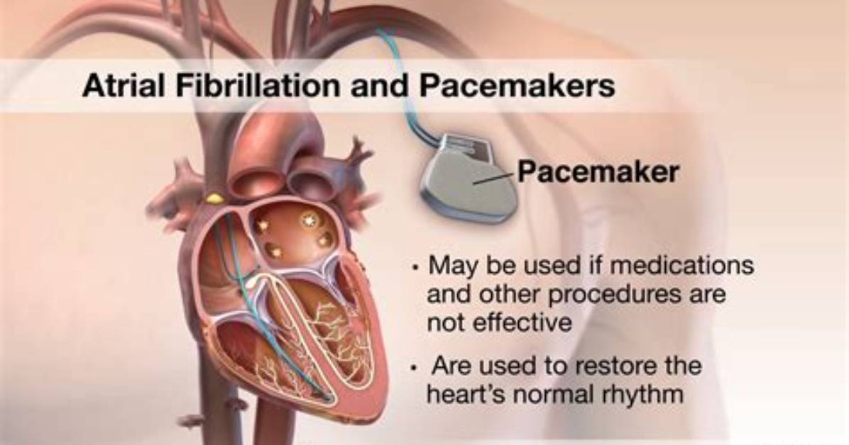 Would a Pacemaker Help Afib?