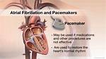 Would a Pacemaker Help Afib?