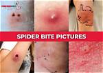 Would a Spider Bite Itch?