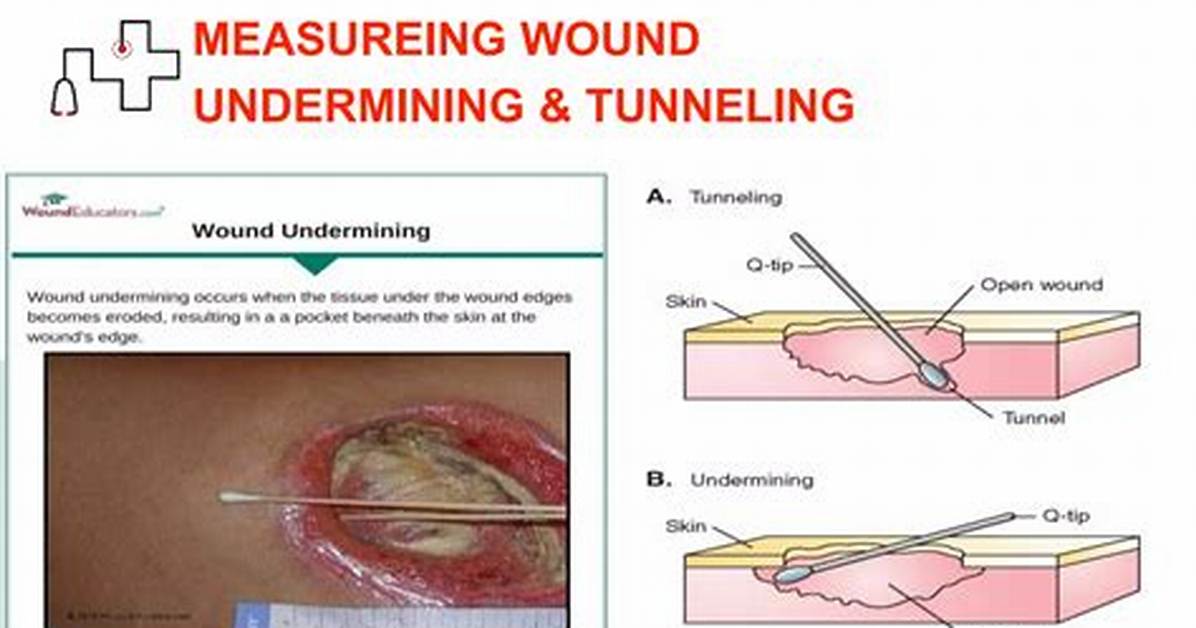 Wound Undermining