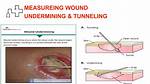 Wound Undermining