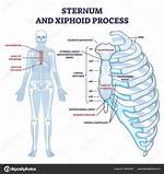Xiphoid Process Protruding