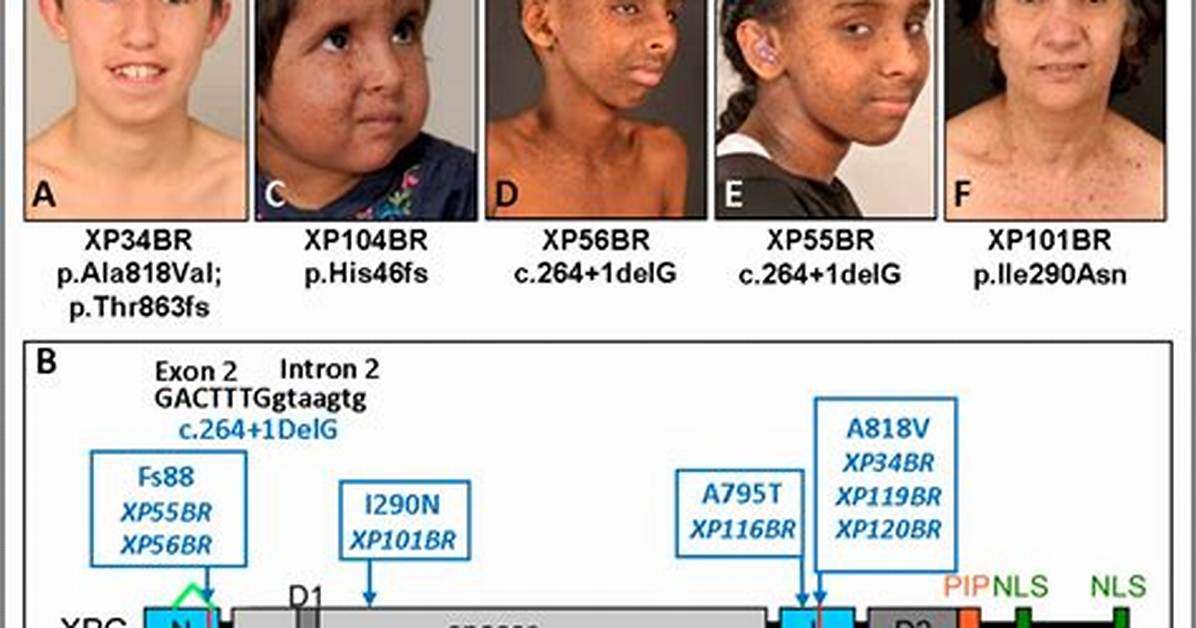 Xp Disease